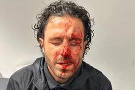 足球流氓！里昂巴士被马赛极端球迷攻击！ 教练受伤缝了12针